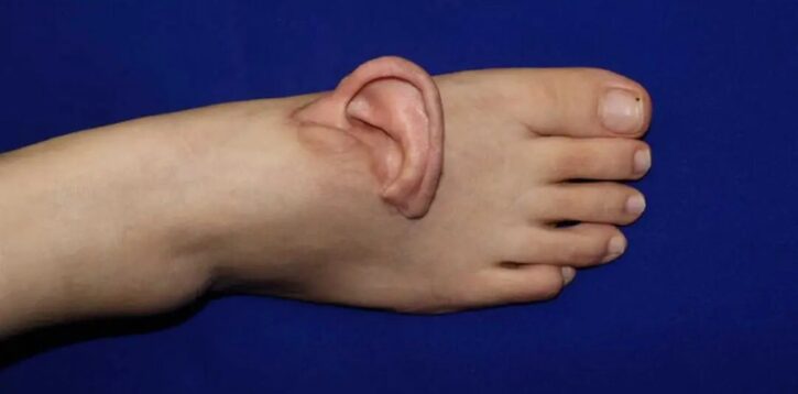 گوش برای اولین بار به پا پیوند زده شد